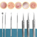 11pcs Blackhead Remover Set Acne Needle Pore Cleaner Skin