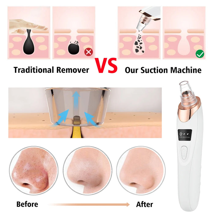 Usb Rechargeable Blackhead Remover For Deep Cleaning